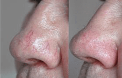 Facial Veins on Nose Before and After