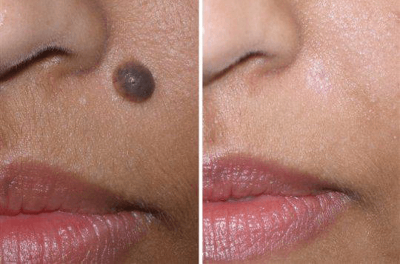 Huge Skin Mole Treatment