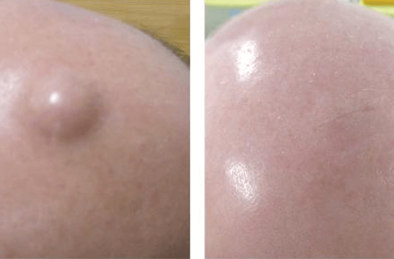Mole Scalp Treatment