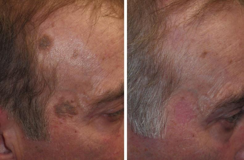Skin Mole Treatment