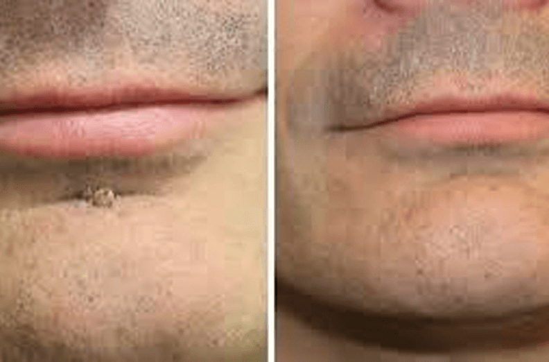 Skin Tag Treatment