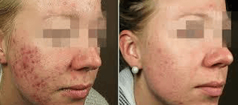 Acne Before and After (With Antibiotics and LED)