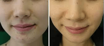 Acne on Face Before and After (With LED)