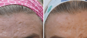 Acne Scarring Before and After (With Dermaroller)