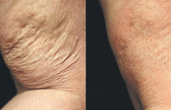 Arm Liposuction Before and After