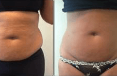 Belly Liposuction Before and After