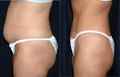 Stomach Liposuction Before and After