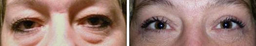Upper Eyelids