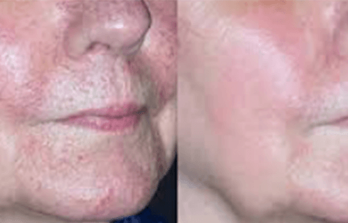 Facial Veins on Face Before and After