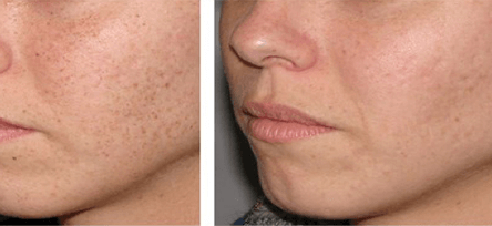Pigmentation Before and After