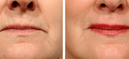 PlexR® Removed Lip Lines