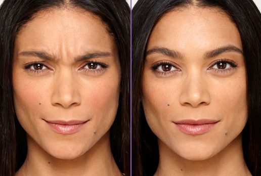 Botox® on Face Before and After