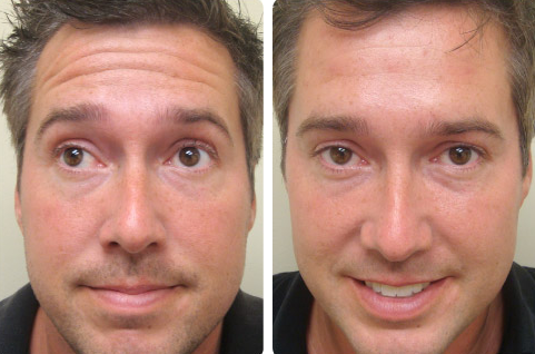 Botox® on Face Before and After