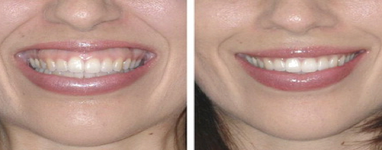 Botox® on Face Before and After