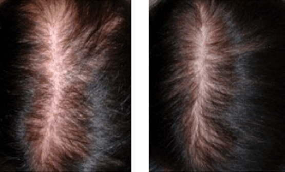 Hair Loss Treatment Before and After