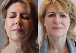 Face and Neck Lift Before and After