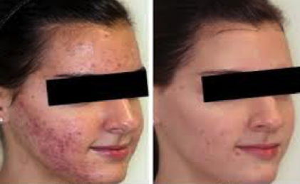Acne Before and After (With Antibiotics, LED and Laser)