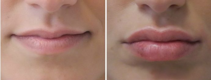Lip Echancement Before and After
