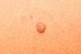 Skin Tags