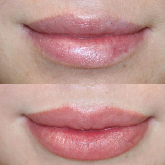 Semi Permanent Lips