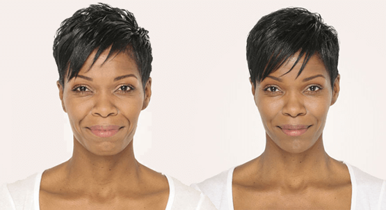 Liquid Face Lift With Dermal Filler