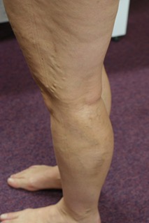 Jackie's Leg Veins After Image