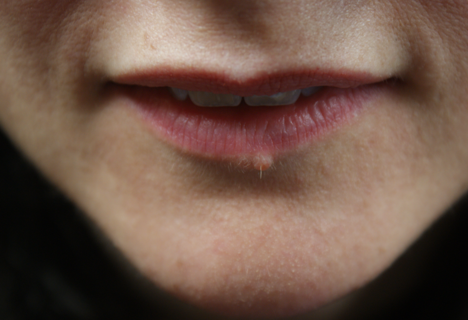 Lip Mole Removal Example Before