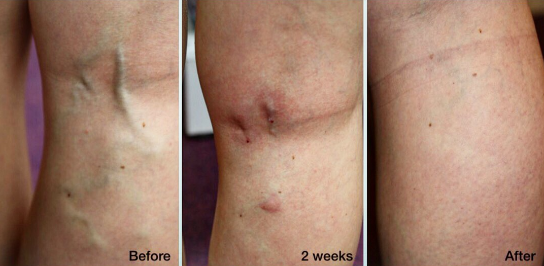 Caroline's Leg Vein Removal Before And After