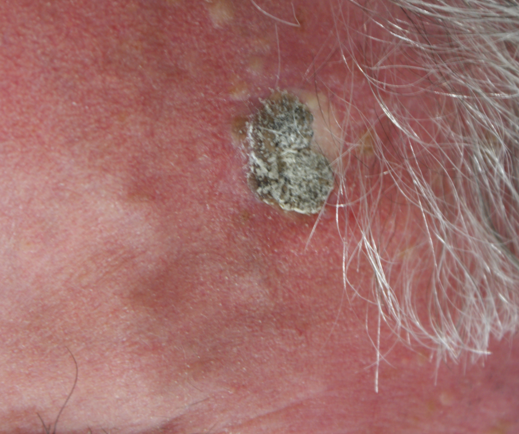 Wart Removal Example Before