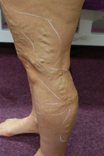 Jackie's Leg Veins Before Image