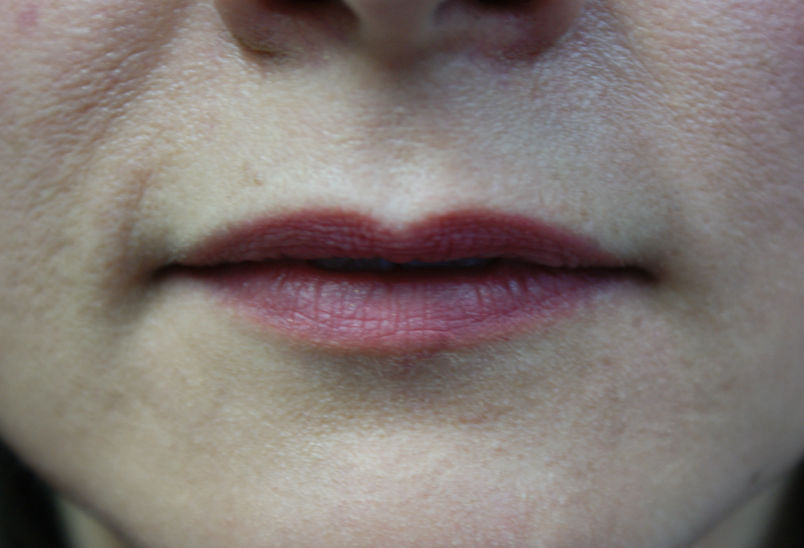 Lip Mole Removal Example After