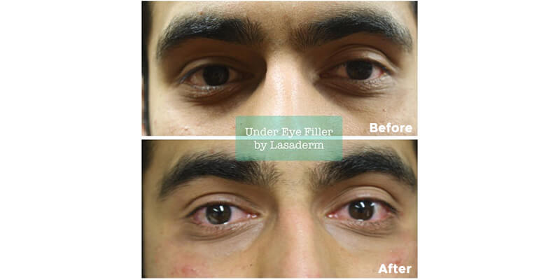 Tear Trough Treatment Before and After