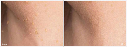Before and After Skin Tags on Armpit