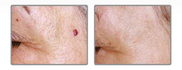 Cherry Haemangioma – Before and After Laser Treatment