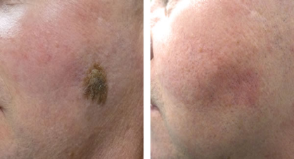 Seborrheic Keratosis Before and After