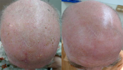 Solar Keratosis Before and After