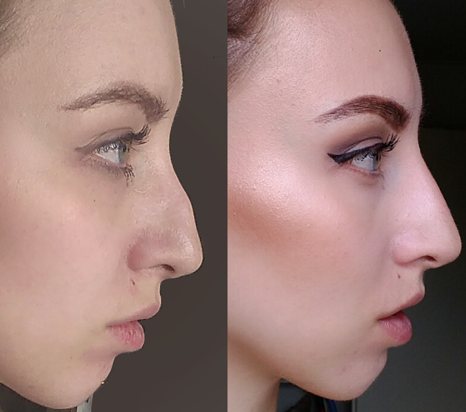 Non-surgical Nose Job Before and After