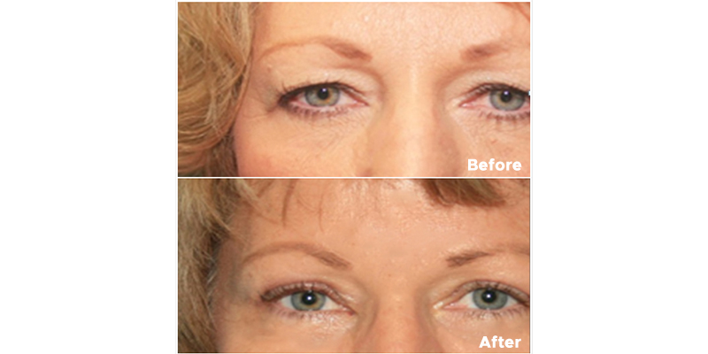 PlexR Eyelids Before and After Images