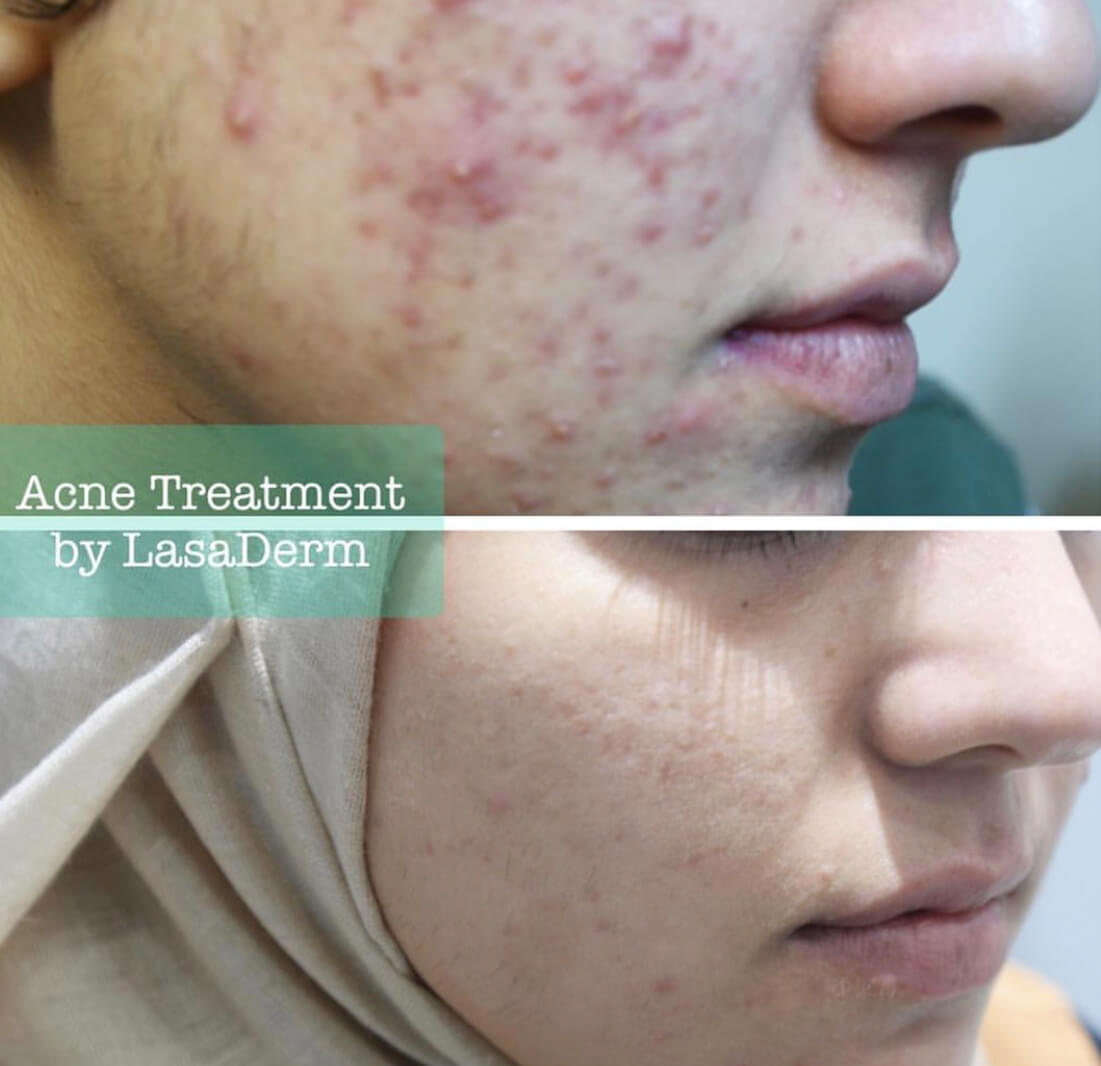 Acne Before & After