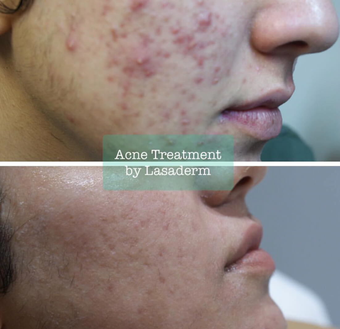 Acne treatments before and after photos