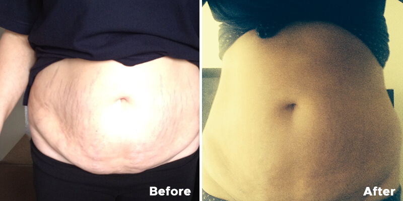 3D Lipo Before and After
