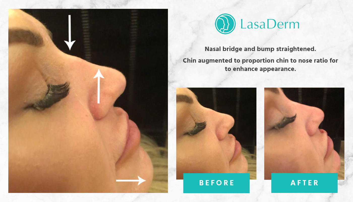 Lunchtime 10 Minute Nose Job