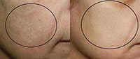 Geneo+ Facial