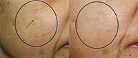 Geneo+ Facial