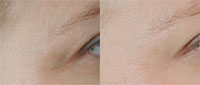 Geneo+ Facial