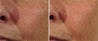 Geneo+ Facial