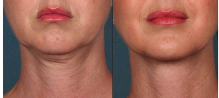 Jaw and Neck PDO Thread Lift Before and After