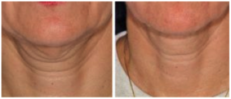 Neck Before and After