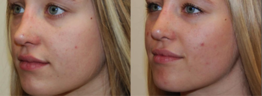 Non-surgical Nose Job Before and After