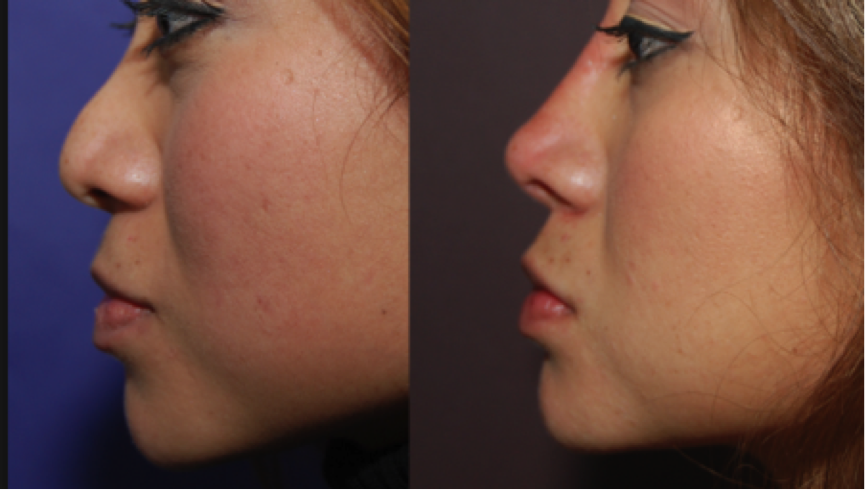 Non-surgical Nose Job Before and After